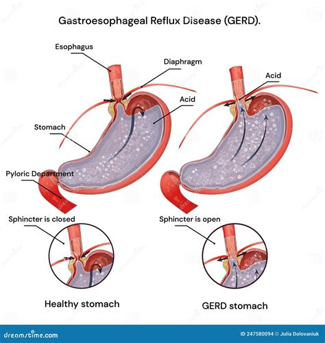 Heartburn And Gastroesophageal Reflux Disease Gerd Acid Reflux