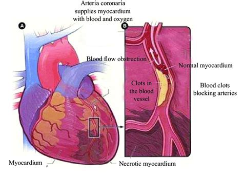 Myocardial Infarction Photo