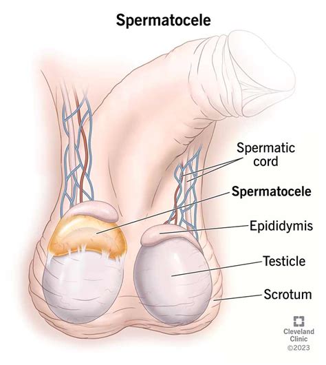 Spermatocele Cēloņi Simptomi Diagnostika Un ārstēšana Lv Sfomc