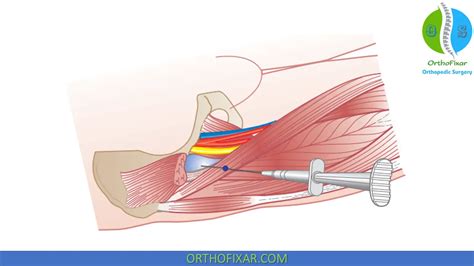 Iliopsoas Bursa Injection Orthofixar