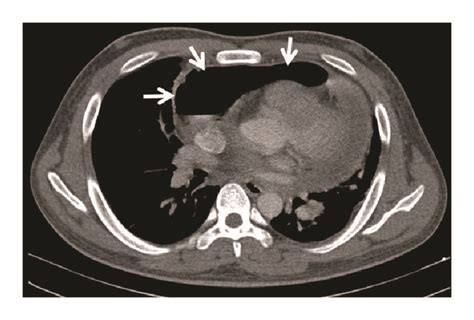 CT scan images. (a) Cross-sectional cut of the heart and pericardium ...