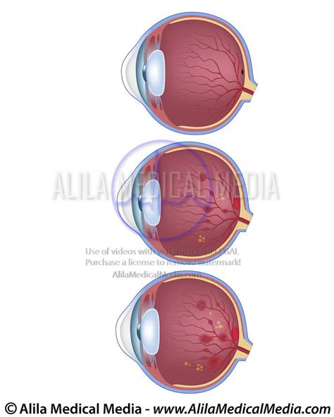 Alila Medical Media Diabetic Retinopathy Unlabeled Diagram