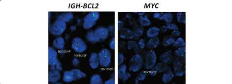 Fish Results From The Diffuse Large B Cell Lymphoma Component Igh Bcl