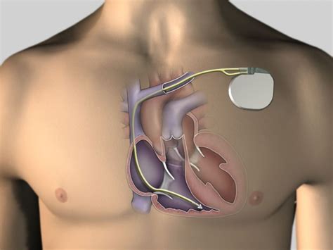 Implantierbarer Defibrillator Icd Hgz G Ttingen