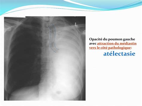 Ppt Imagerie Du Cancer Bronchique And Classification Tnm Powerpoint