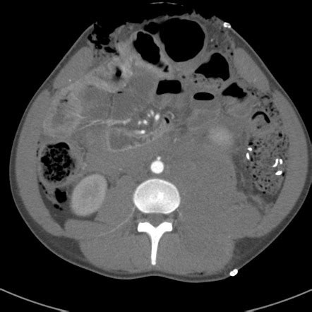 Penetrating abdominal trauma | Radiology Case | Radiopaedia.org