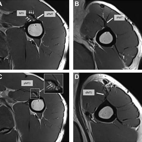 Values Of Musculotendinous Junction Measurements According To Patient Download Scientific