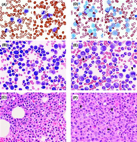 Natural History Of Chronic Myelomonocytic Leukemia Gene Sequencing