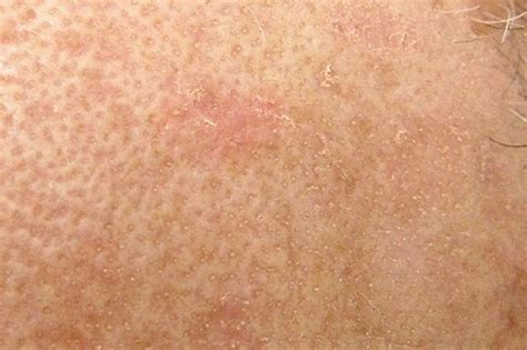 Hautkrebs Vorsorge Kontrolle Behandlung Dermatologie