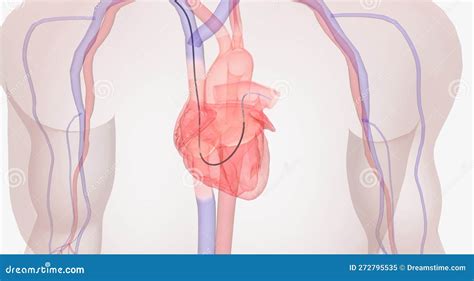 The Diagnostic Right Heart Catheterization Stock Illustration ...