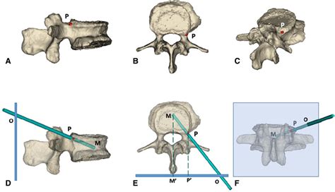 Pedicle Fracture