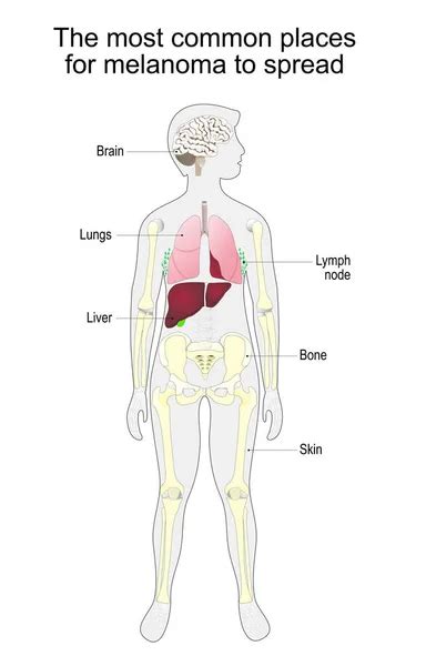 Stages Melanoma Tnm Classification Malignant Tumors Metastasis Skin