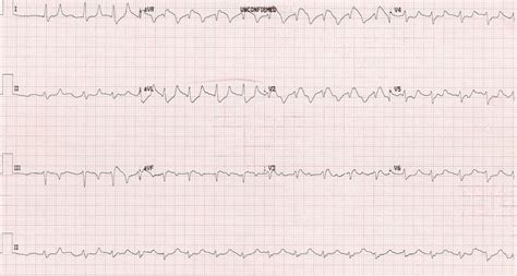 Severe Hyperkalemia Ecg