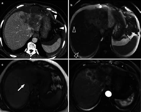 Other Malignant Tumors Of The Liver Radiology Key