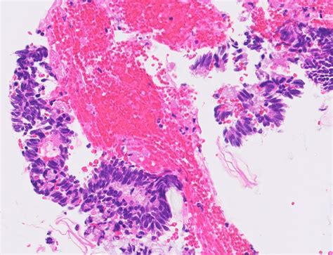 Pathology Outlines Adenocarcinoma In Situ