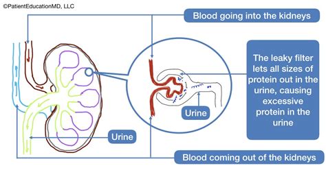 Protein Loss In Urine Proteinuria Symptoms Causes And 45 Off