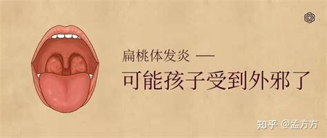 今天为大家分享，孩子为什么老是扁桃体发炎？ 知乎