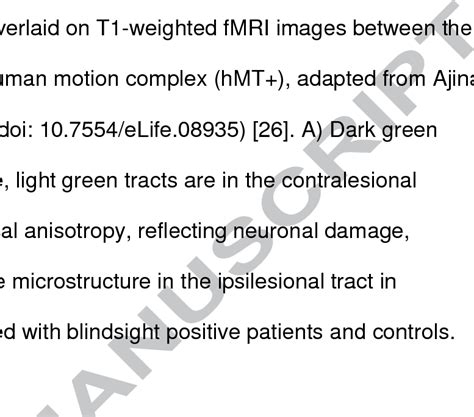 Testing of a subject with left homonymous hemianopsia visual field ...