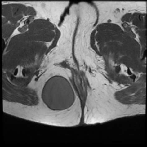 Perirectal Cyst