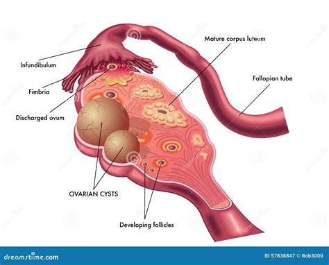 Ovarian Cyst Stock Vector Illustration Of Reproductive 57838847