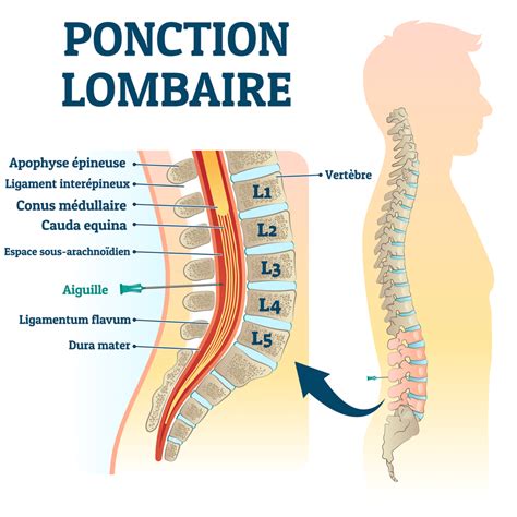 Ponction Lombaire Techniques Et D Roulement