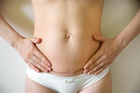 Toning Stomach After C Section