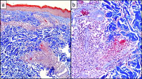 Skin biopsy. (a) Microscopic examination demonstrates the... | Download ...