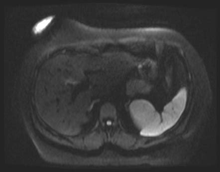 Cystic Duct Stump Stones Residual Post Cholecystectomy Image