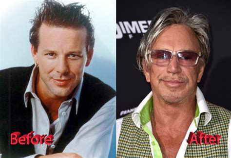 Mickey Rourke Plastic Surgery Gone Bad - Plastic Surgery Mistakes