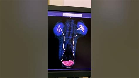 urography Ct scan of urogram | urology #video #trending #ctscan # ...