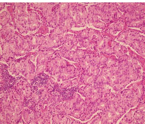 Section From Lymph Node Shows Metastatic Adenocarcinoma Hande×250 Download Scientific Diagram