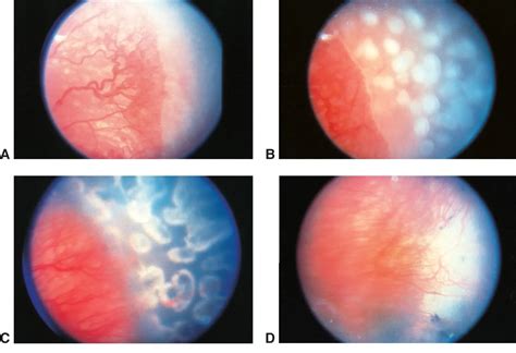 Retinopathy Of Prematurity American Academy Of Ophthalmology