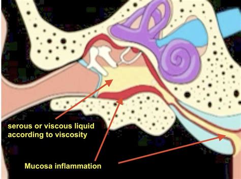 Chronic Otitis Media With Effusion Le Blog De Lorl