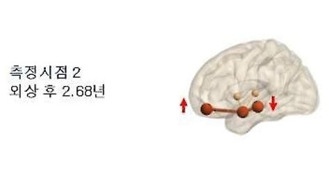 공포의 기억 지울 수 있다ptsd 치료법 기대↑