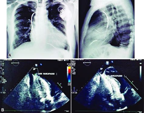 Radiografia De T Rax A E Ecocardiografia Transtor Cica B No Quinto