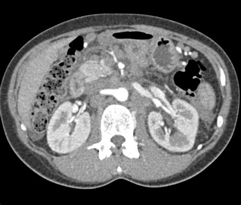 Pancreatic Adenocarcinoma With Extensive Adenopathy Liver Metastases