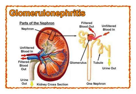 Glomerulonephritis Causes Symptoms Diagnosis Treatment 52 OFF