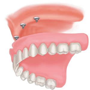 Implant-Supported Dentures - South Calgary Periodontal Group