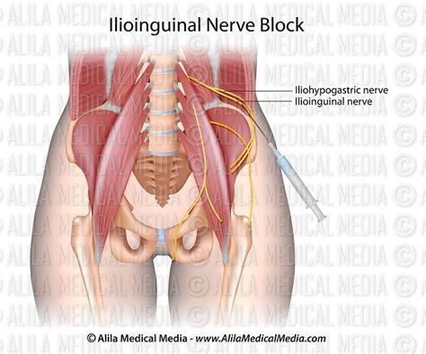 Alila Medical Media Ilioinguinal Nerve Block Medical Illustration