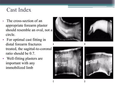 Plaster of paris ,synthetic casts and Functional cast bracing | PPT