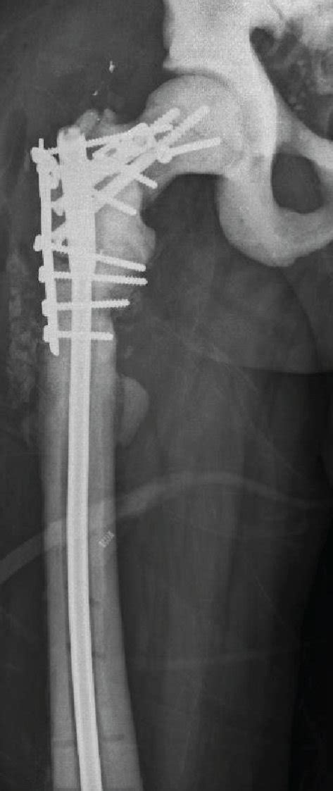 Postoperative anteroposterior radiograph of the femur after the last ...