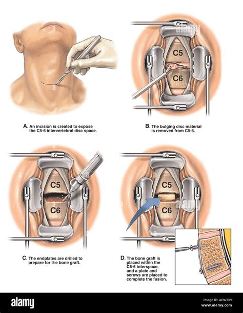 Cirugía de fusión vertebral C5 6 discectomía cervical anterior ...