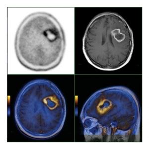 Beyin Tümörlerinde PET CT Nasıl Kullanılır Acil Servis