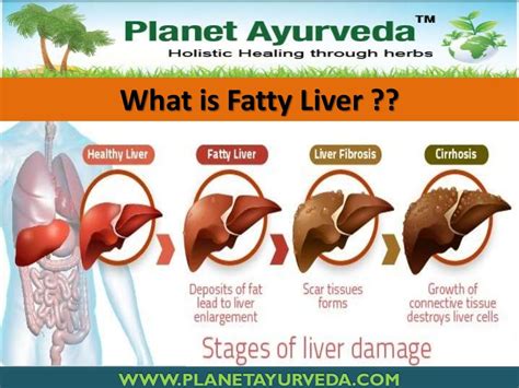 Ayurvedic Treatment For Fatty Liver Natural Cure For Fat Accumulati