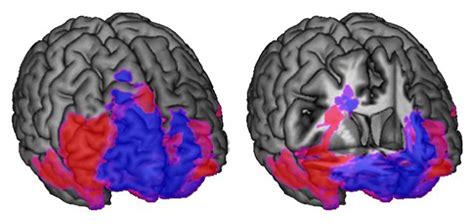 Role of the Frontal Lobes in Reasoning and Decision Making