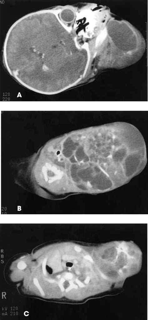 Congenital Cervical Teratoma Airway Management And Complications