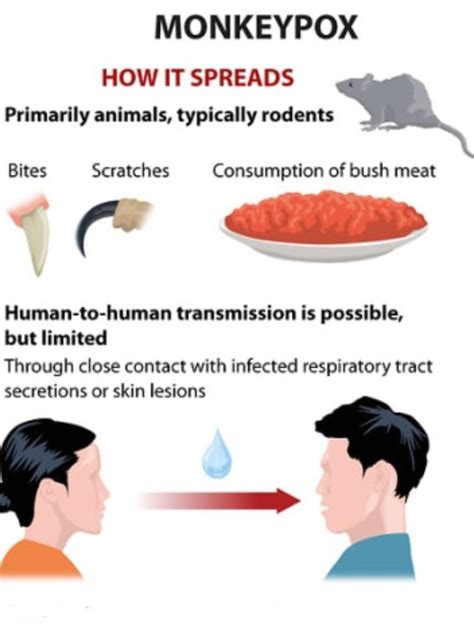 Monkeypox in India Symptoms & Treatment - MixIndia