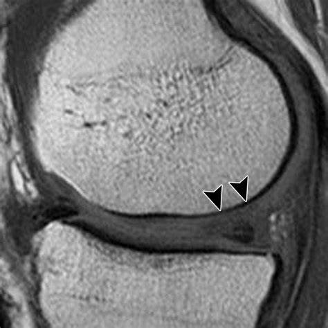 Articular Cartilage In The Knee Current Mr Imaging Techniques And Applications In Clinical