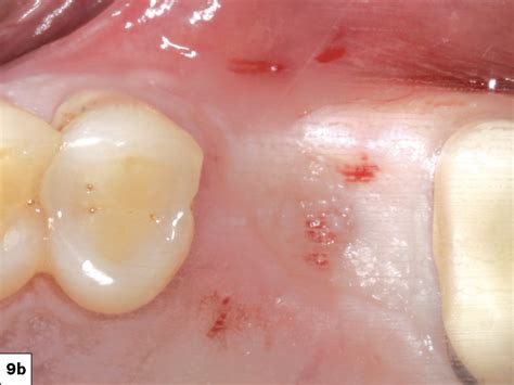 Maxillary First Molar Extract Socket Grafting And Sinus Lift