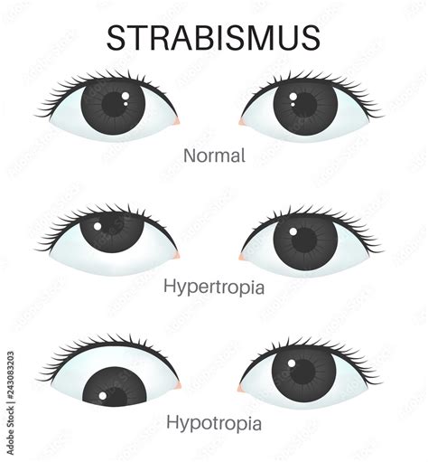 Types of strabismus - Hypertropia and Hypotropia Stock 벡터 | Adobe Stock